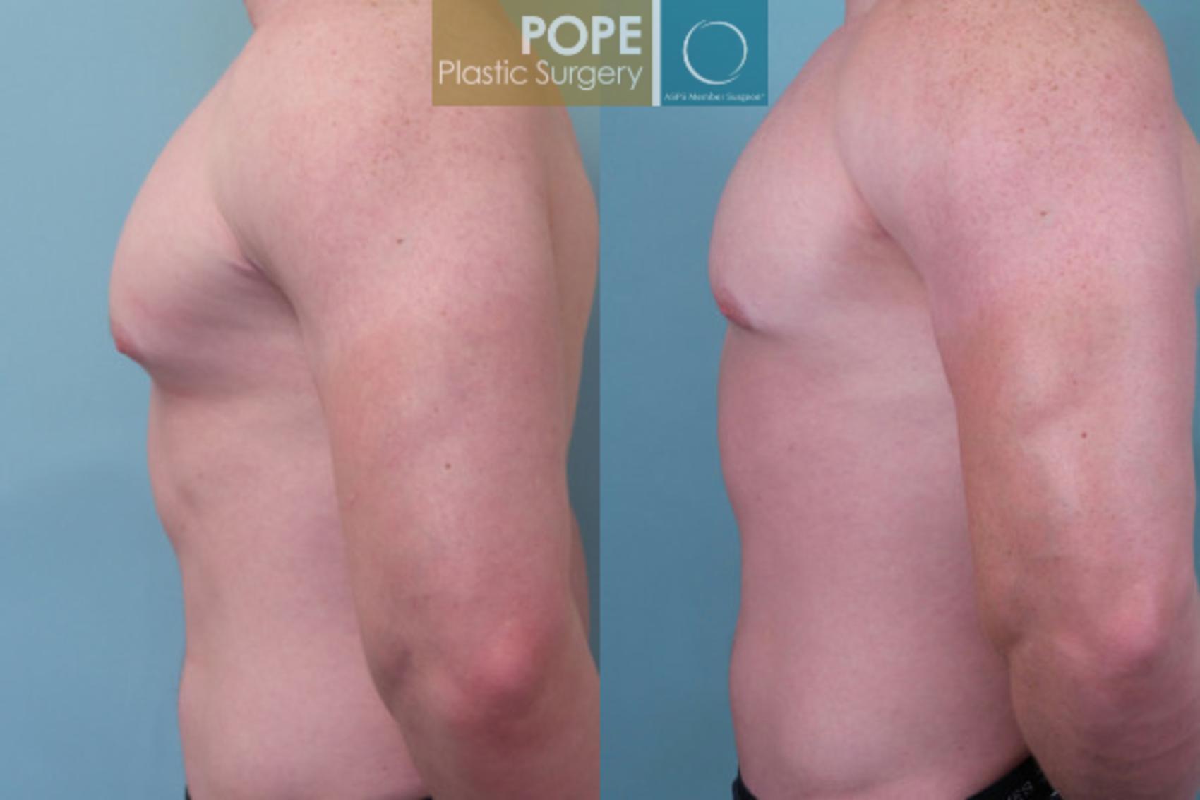 Before & After Male Breast Reduction Case 52 View #3 View in Orlando, FL