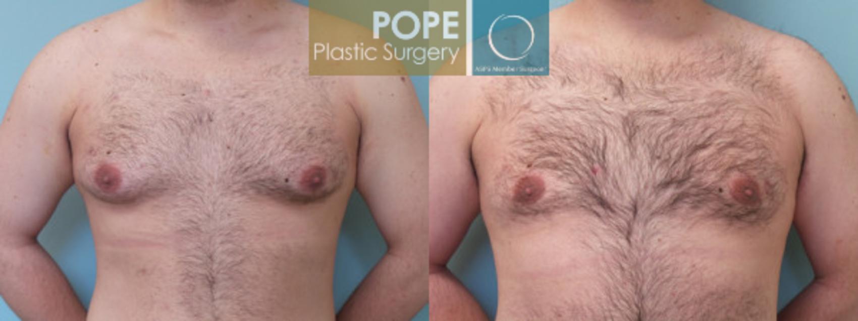 Before & After Male Breast Reduction Case 53 View #1 View in Orlando, FL