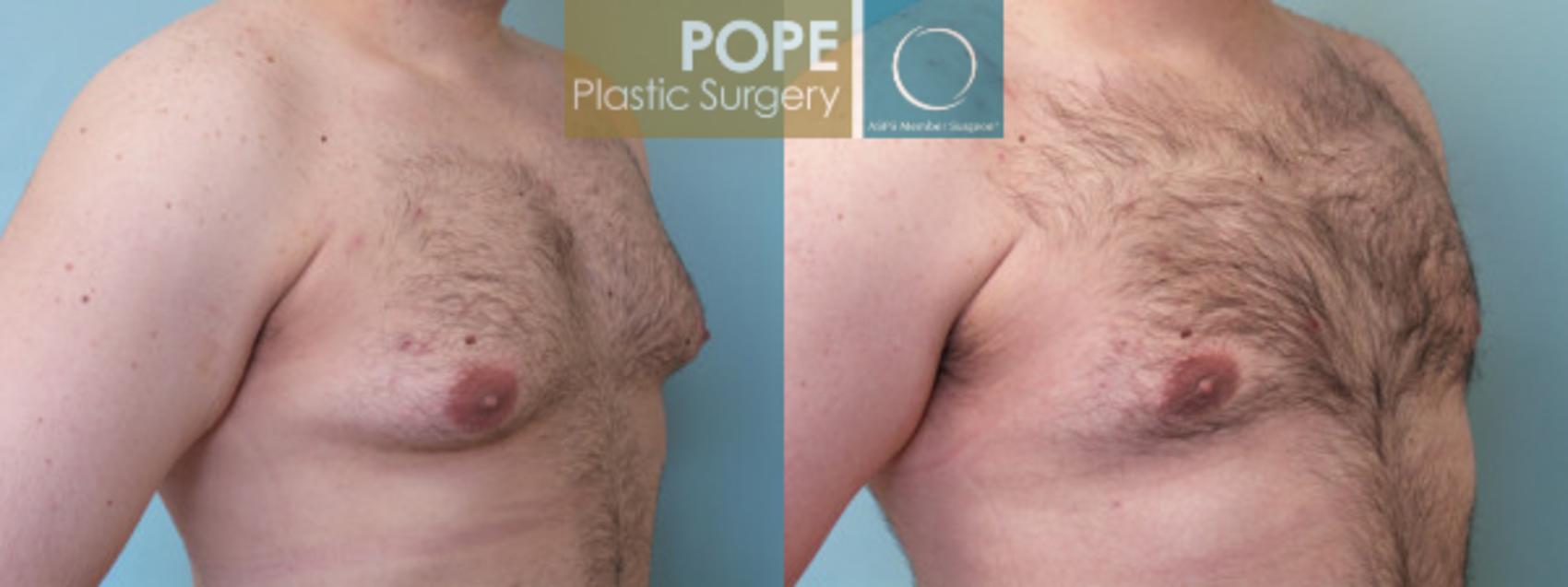 Before & After Male Breast Reduction Case 53 View #2 View in Orlando, FL