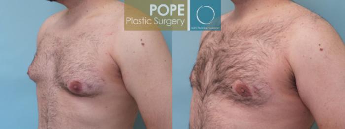 Before & After Male Breast Reduction Case 53 View #3 View in Orlando, FL