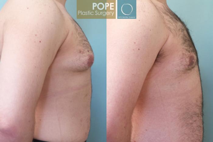 Before & After Male Breast Reduction Case 53 View #4 View in Orlando, FL