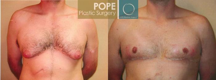 Before & After Male Breast Reduction Case 94 View #1 View in Orlando, FL