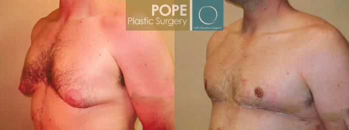 Before & After Male Breast Reduction Case 94 View #2 View in Orlando, FL
