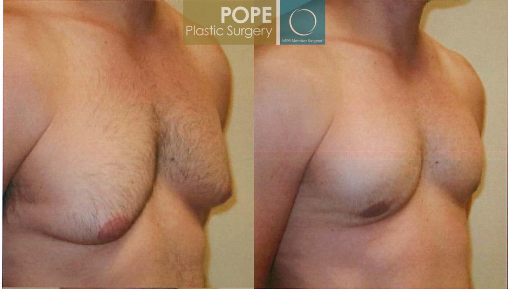 Before & After Male Breast Reduction Case 95 View #2 View in Orlando, FL