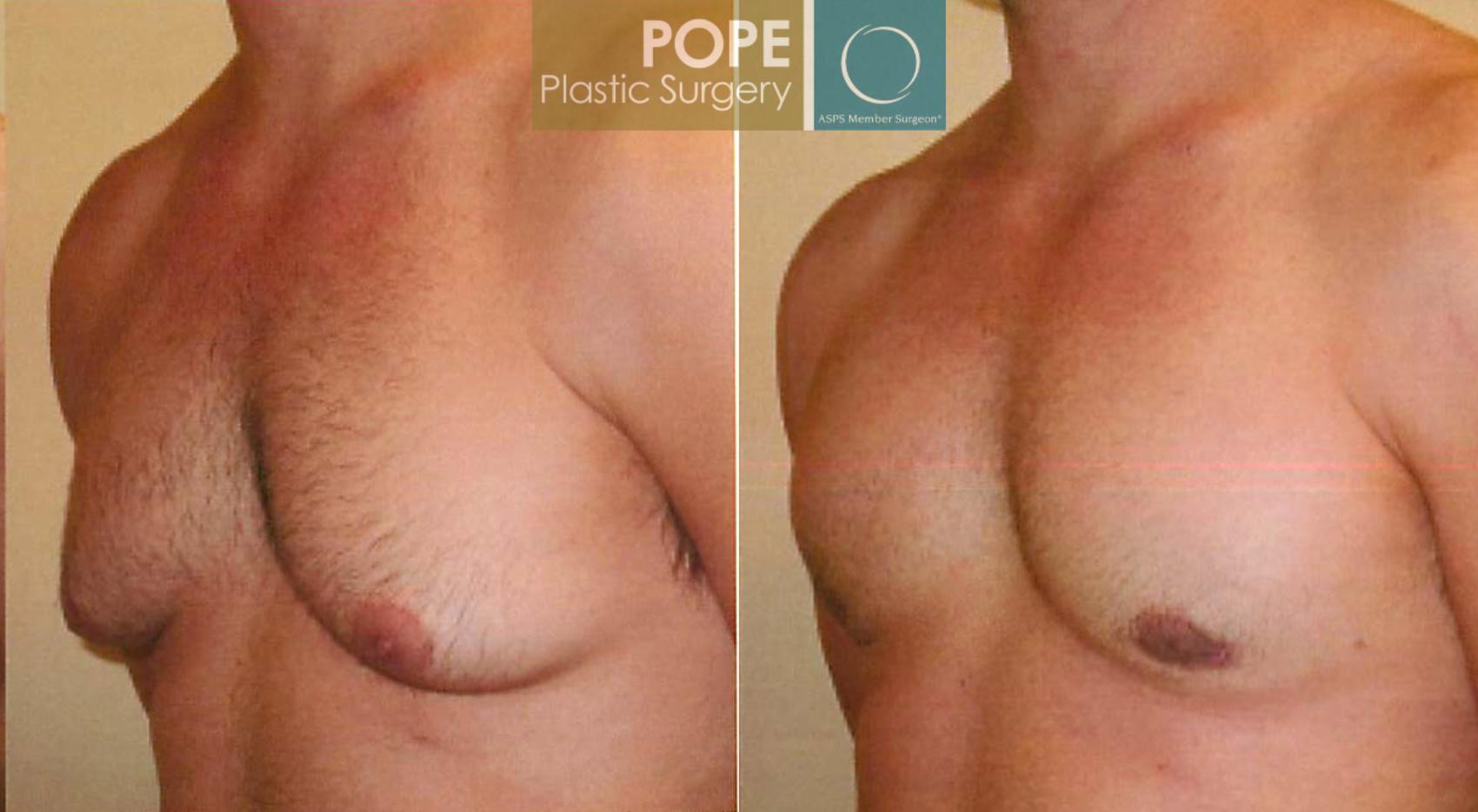 Before & After Male Breast Reduction Case 95 View #3 View in Orlando, FL