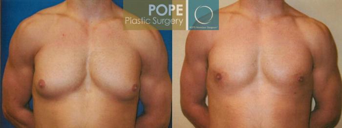 Before & After Male Breast Reduction Case 96 View #1 View in Orlando, FL