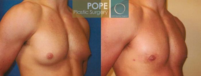 Before & After Male Breast Reduction Case 96 View #2 View in Orlando, FL
