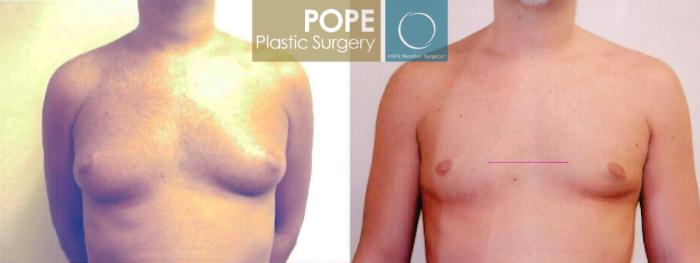 Before & After Male Breast Reduction Case 97 View #1 View in Orlando, FL