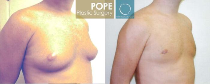 Before & After Male Breast Reduction Case 97 View #2 View in Orlando, FL