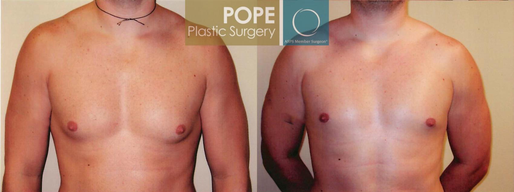 Before & After Male Breast Reduction Case 98 View #1 View in Orlando, FL