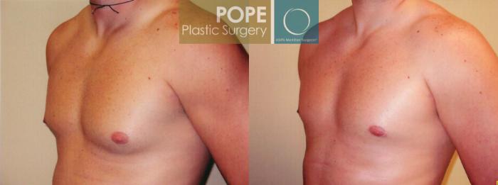 Before & After Male Breast Reduction Case 98 View #2 View in Orlando, FL