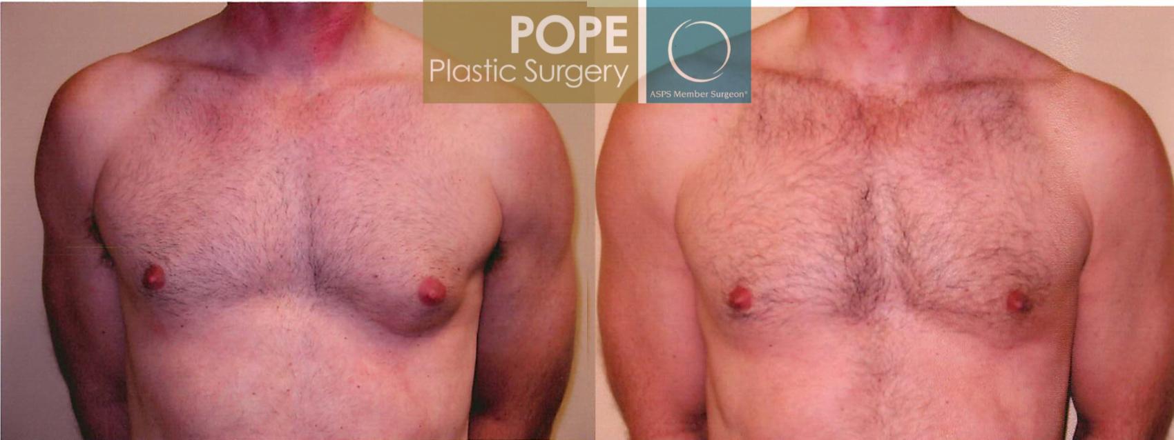 Before & After Male Breast Reduction Case 99 View #1 View in Orlando, FL