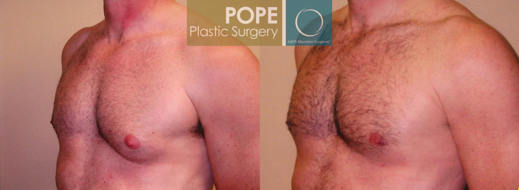 Before & After Male Breast Reduction Case 99 View #2 View in Orlando, FL
