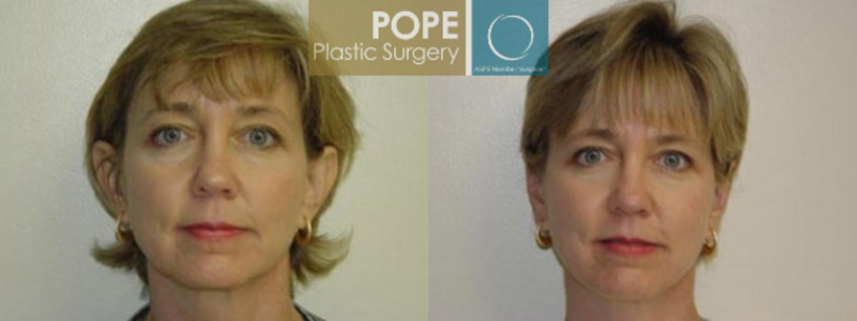 Before & After Otoplasty Case 166 View #1 View in Orlando, FL