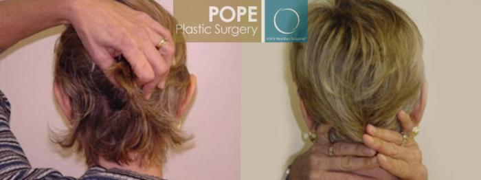 Before & After Otoplasty Case 166 View #2 View in Orlando, FL