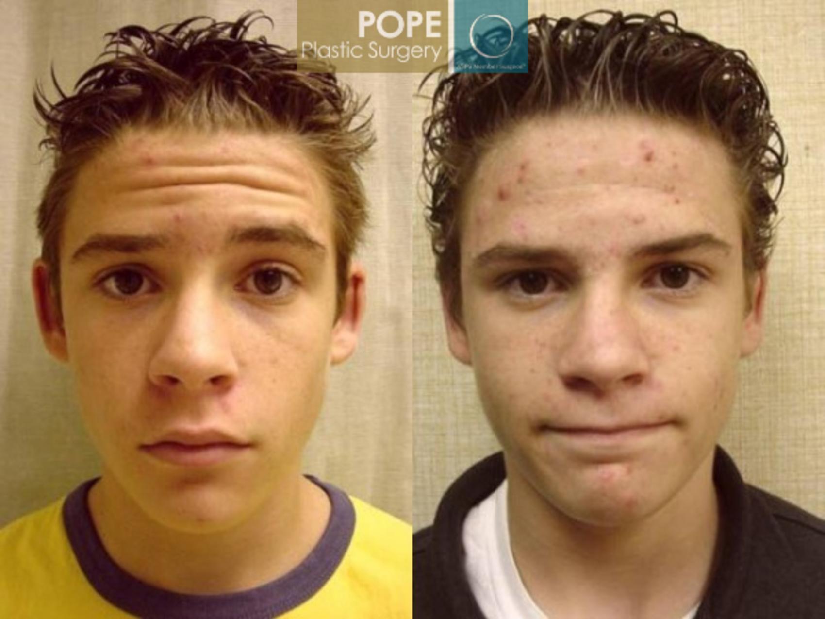 Before & After Otoplasty Case 167 View #1 View in Orlando, FL