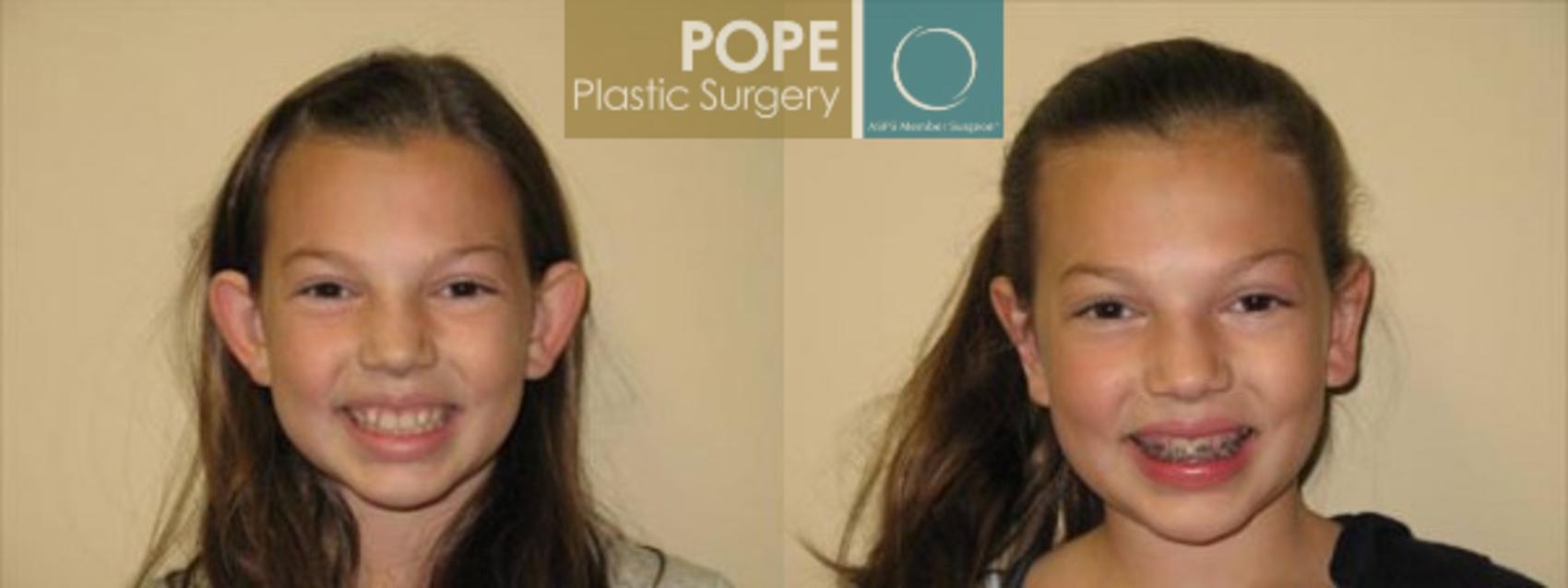 Before & After Otoplasty Case 168 View #1 View in Orlando, FL