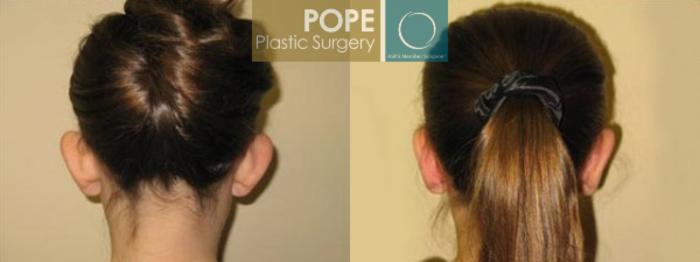 Before & After Otoplasty Case 168 View #2 View in Orlando, FL
