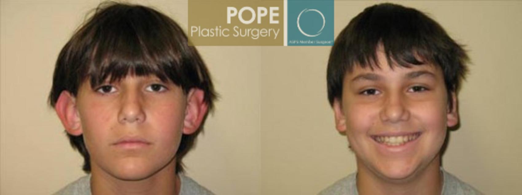 Before & After Otoplasty Case 169 View #1 View in Orlando, FL
