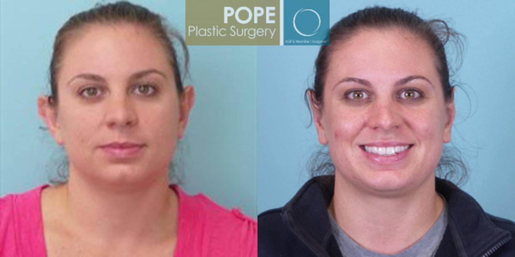 Before & After Otoplasty Case 170 View #1 View in Orlando, FL