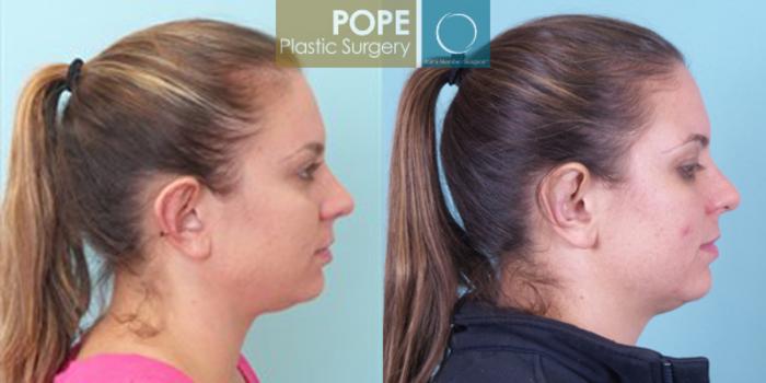 Before & After Otoplasty Case 170 View #2 View in Orlando, FL