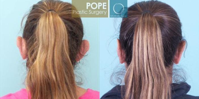 Before & After Otoplasty Case 170 View #3 View in Orlando, FL