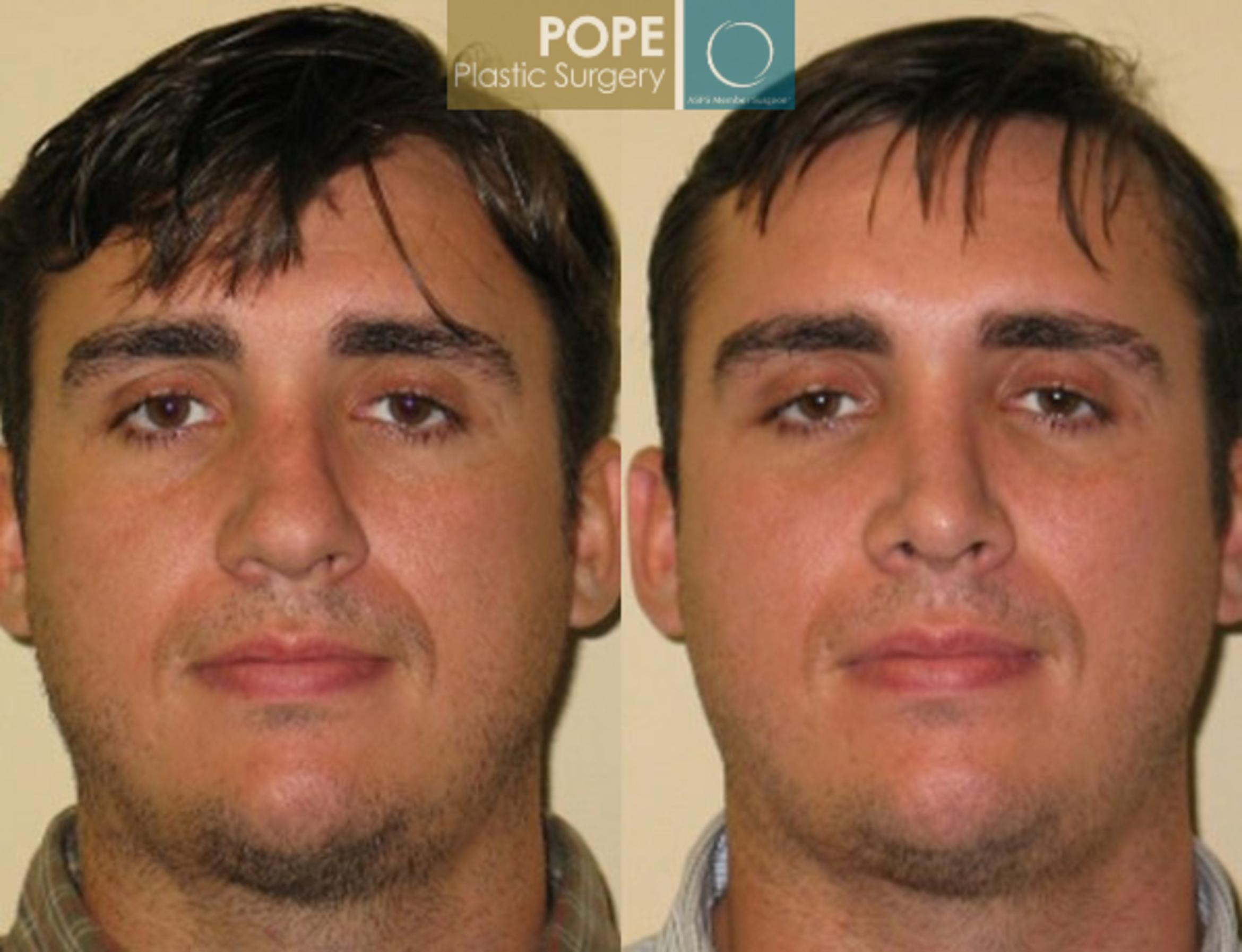 Before & After Rhinoplasty Case 171 View #1 View in Orlando, FL