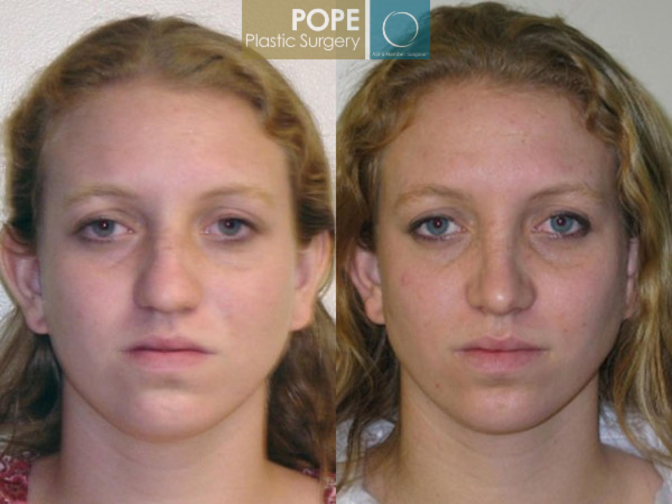 Before & After Rhinoplasty Case 172 View #1 View in Orlando, FL