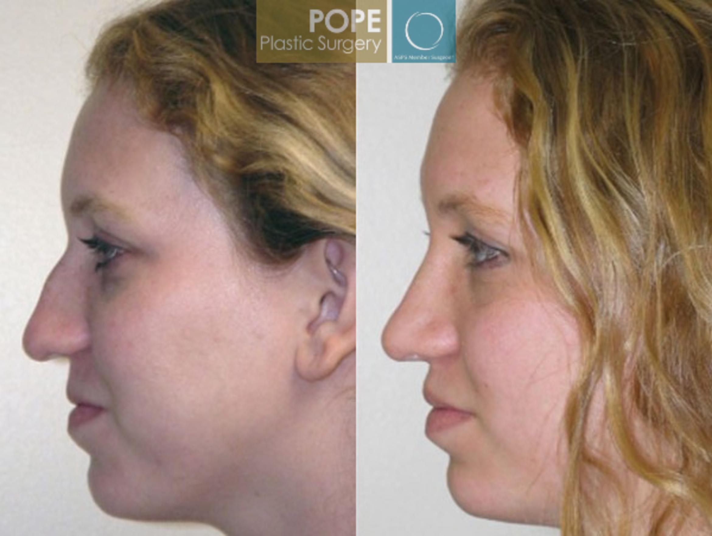 Before & After Rhinoplasty Case 172 View #2 View in Orlando, FL