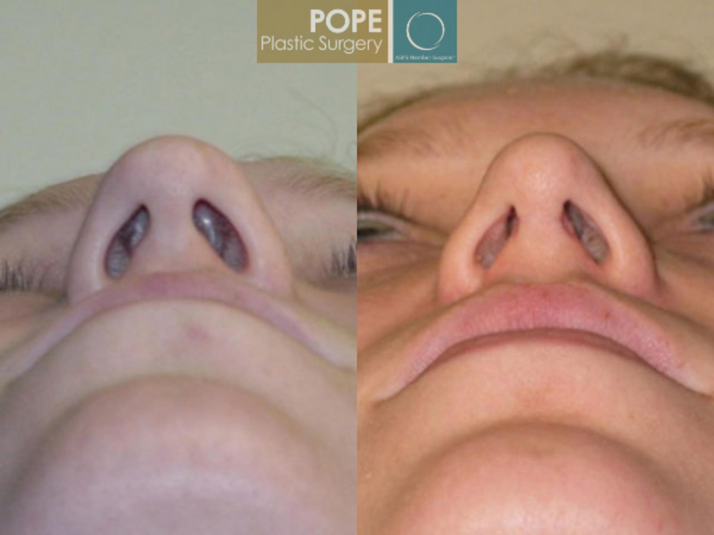 Before & After Rhinoplasty Case 172 View #3 View in Orlando, FL