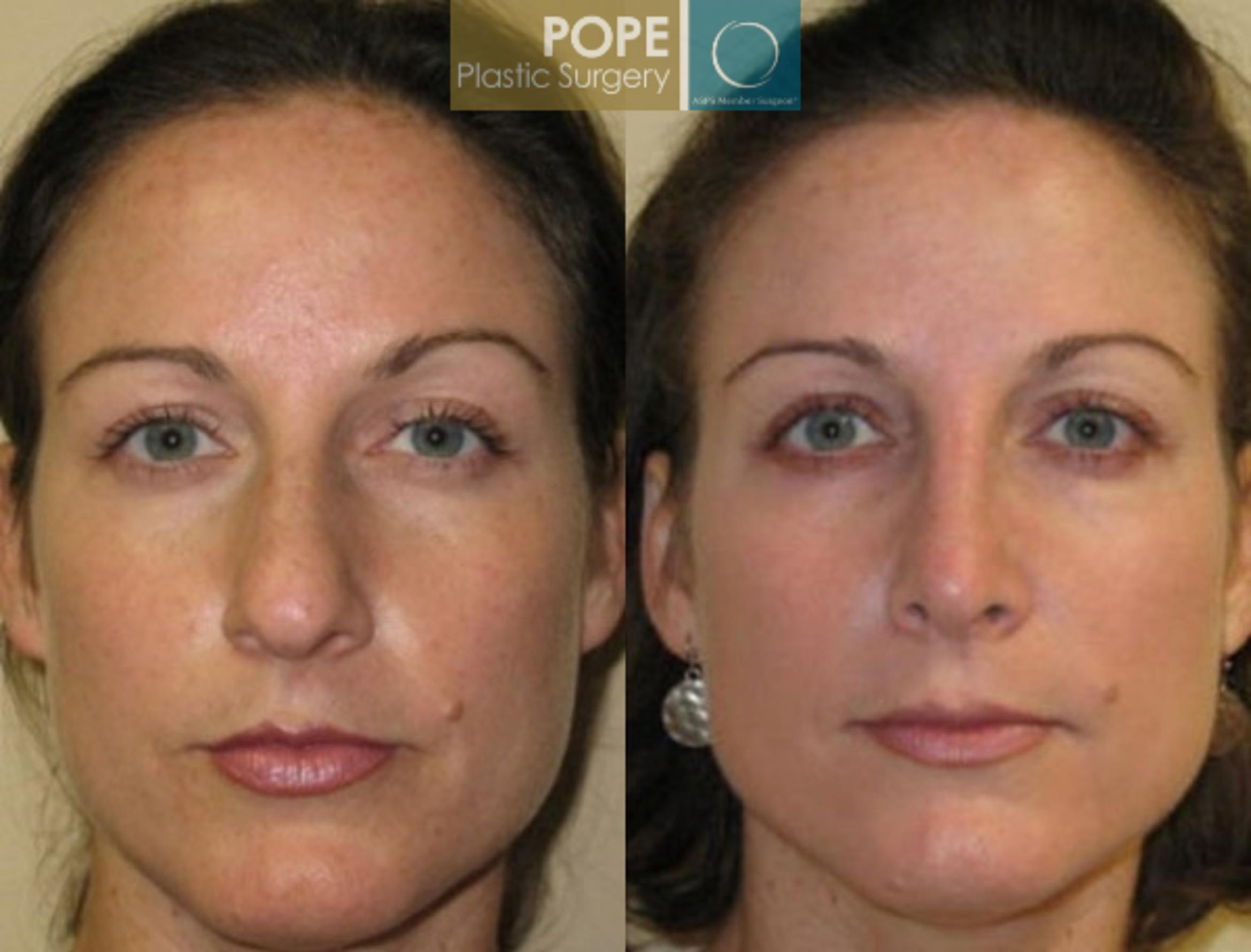 Before & After Rhinoplasty Case 173 View #1 View in Orlando, FL