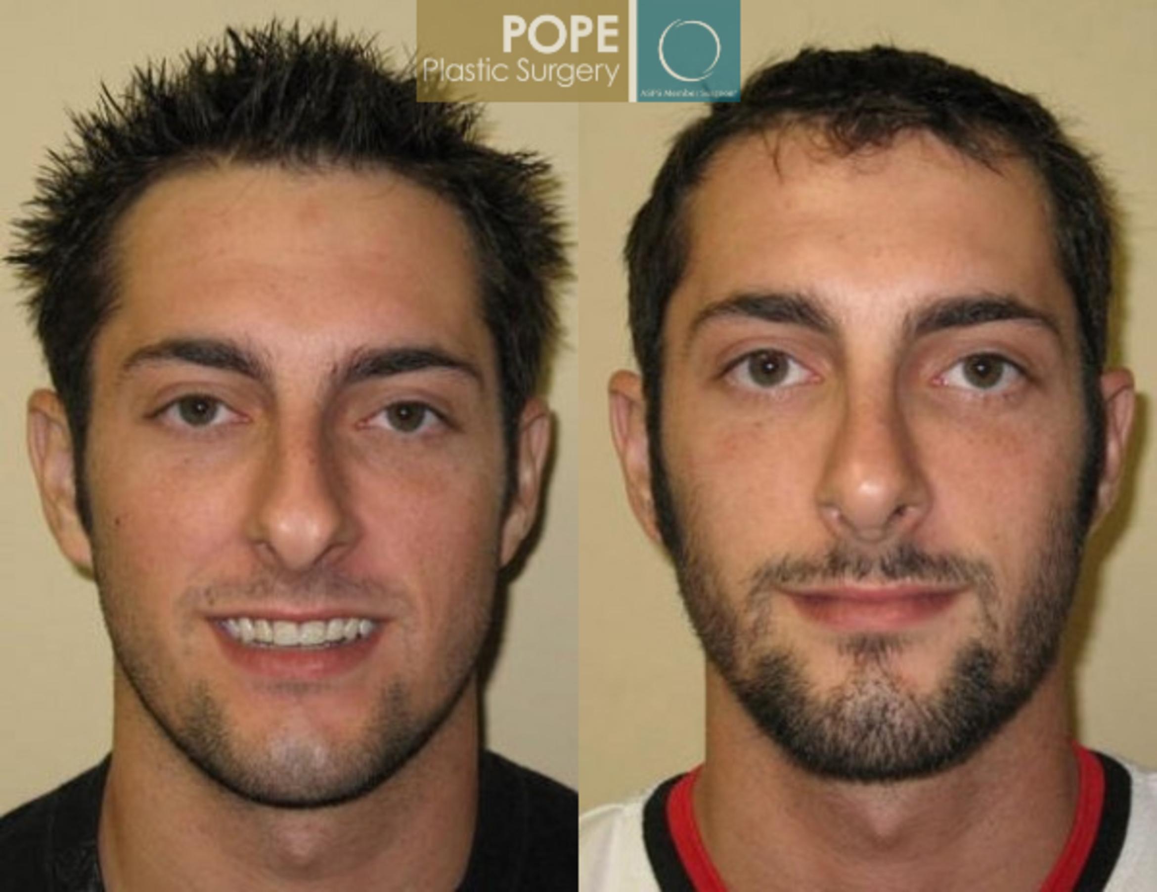 Before & After Rhinoplasty Case 174 View #1 View in Orlando, FL