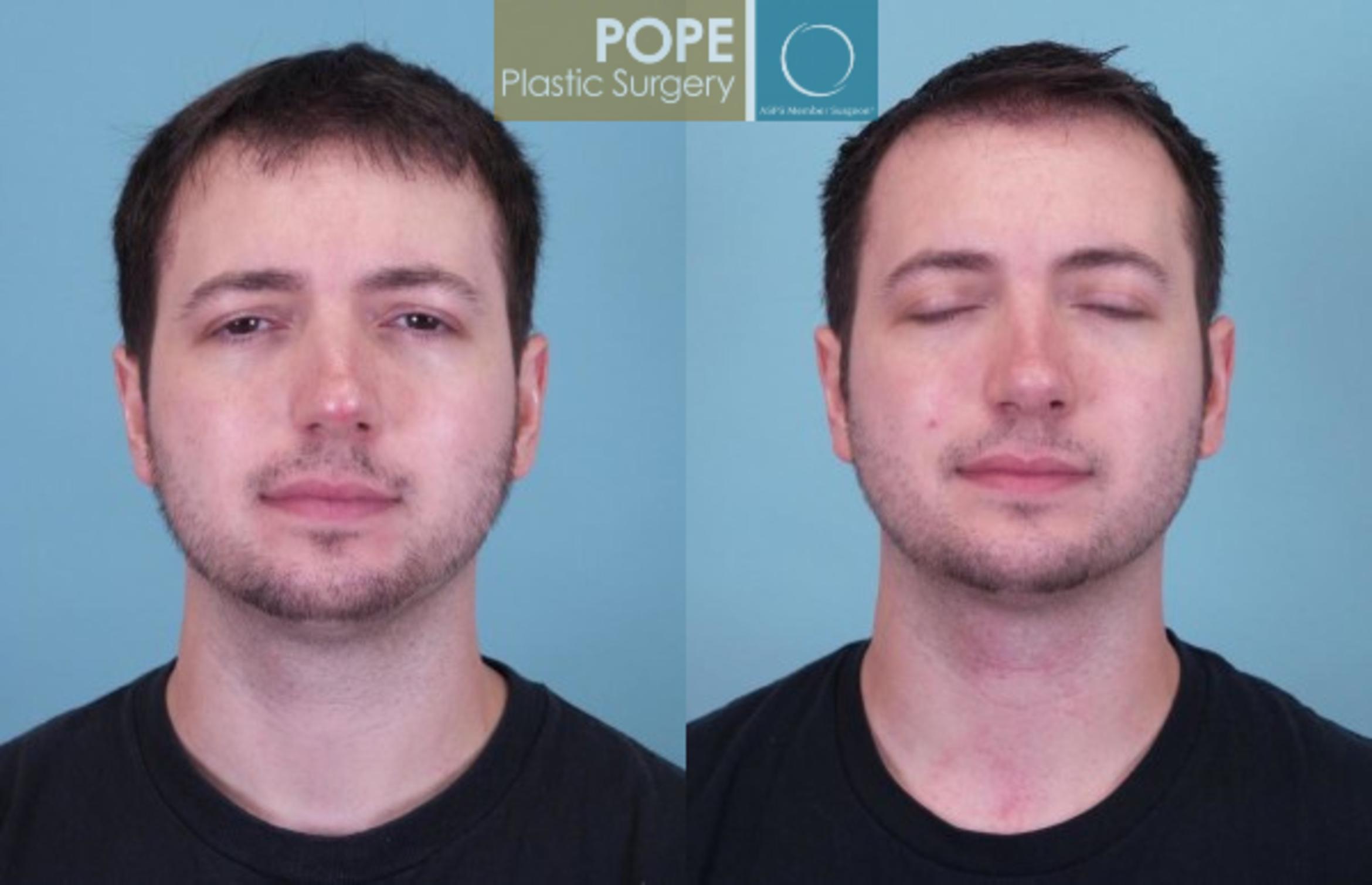 Before & After Rhinoplasty Case 175 View #1 View in Orlando, FL