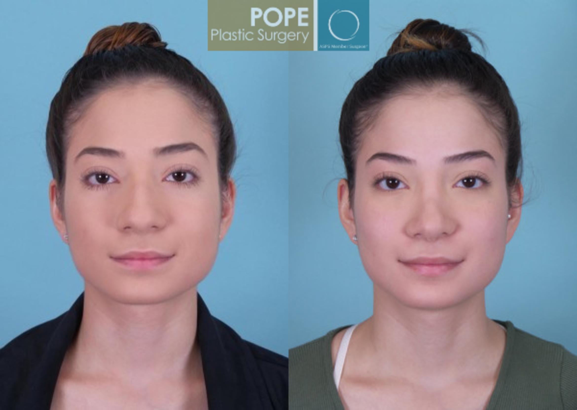 Before & After Rhinoplasty Case 178 View #1 View in Orlando, FL