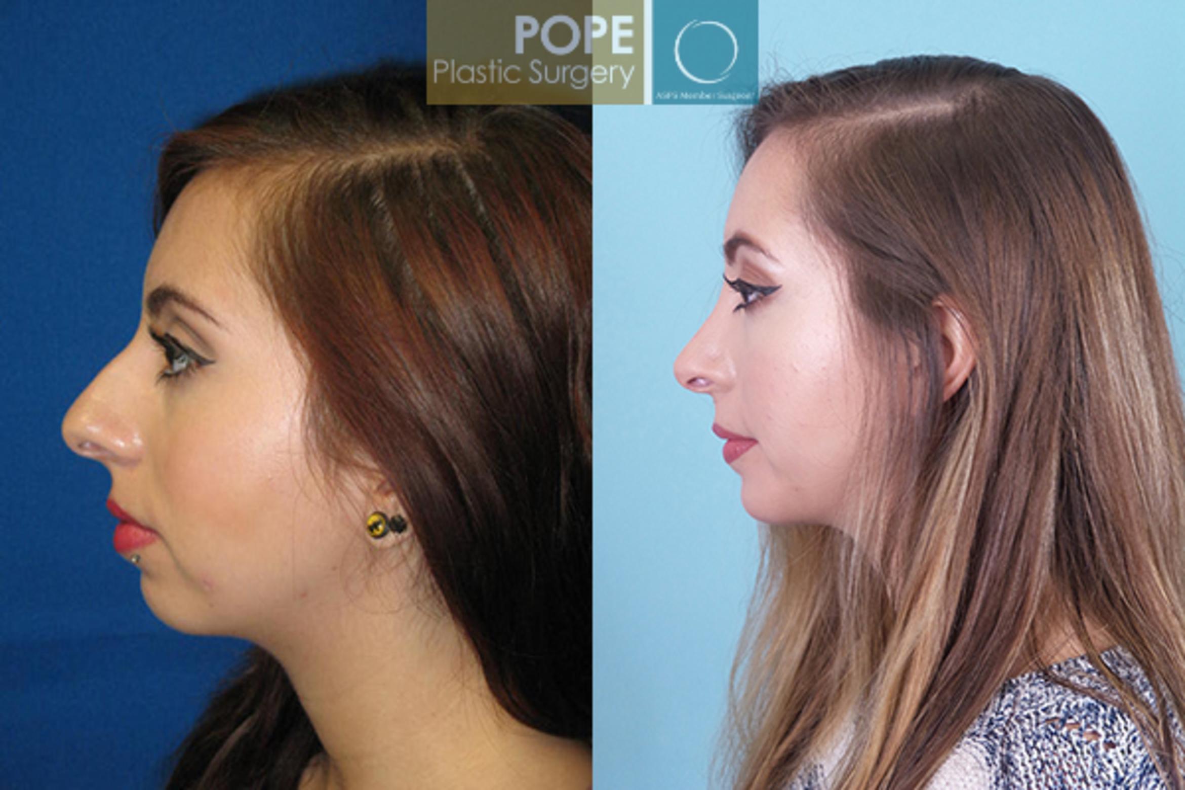 Before & After Featured Cases Case 29 View #2 View in Orlando, FL