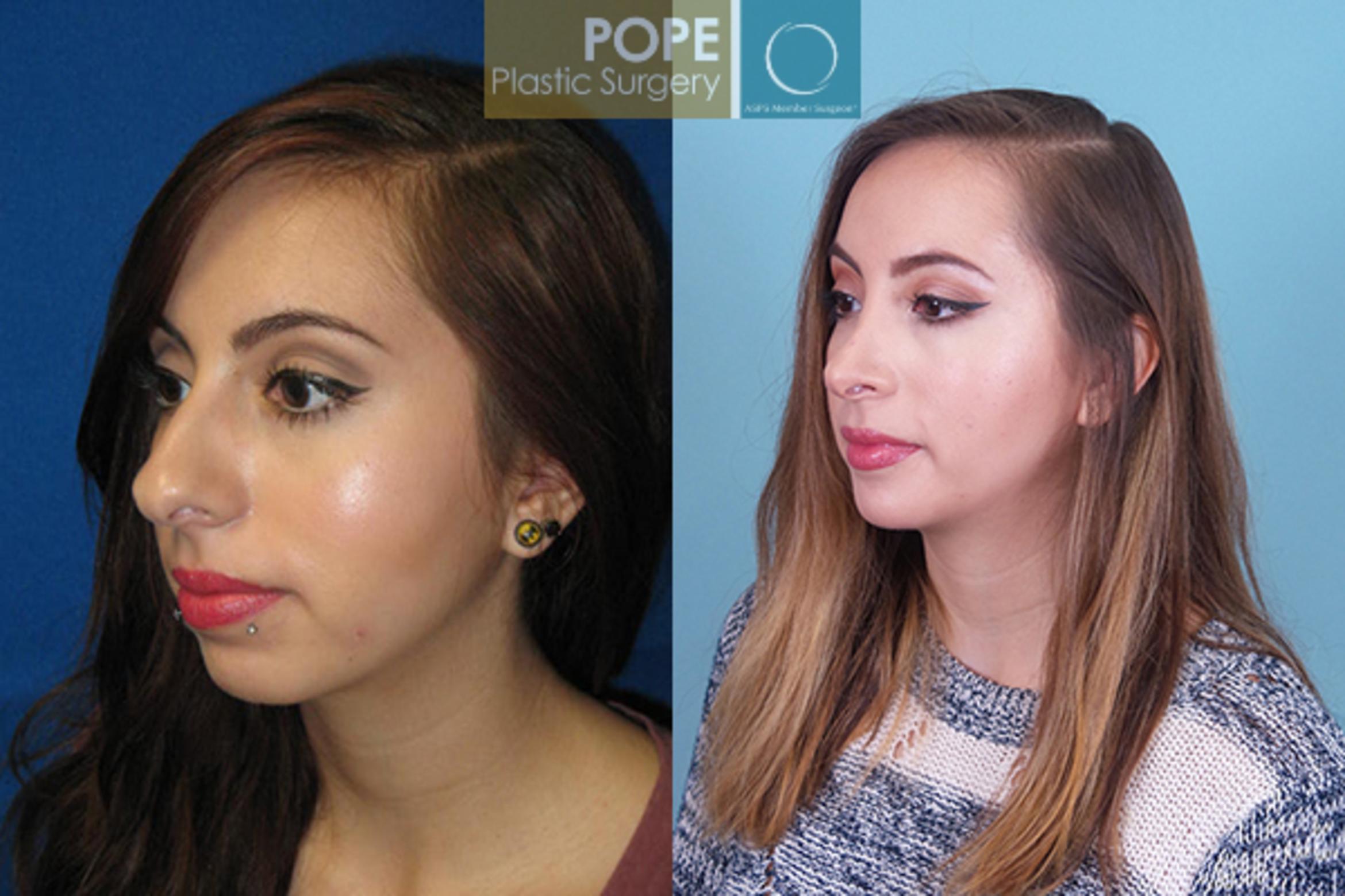 Before & After Featured Cases Case 29 View #4 View in Orlando, FL