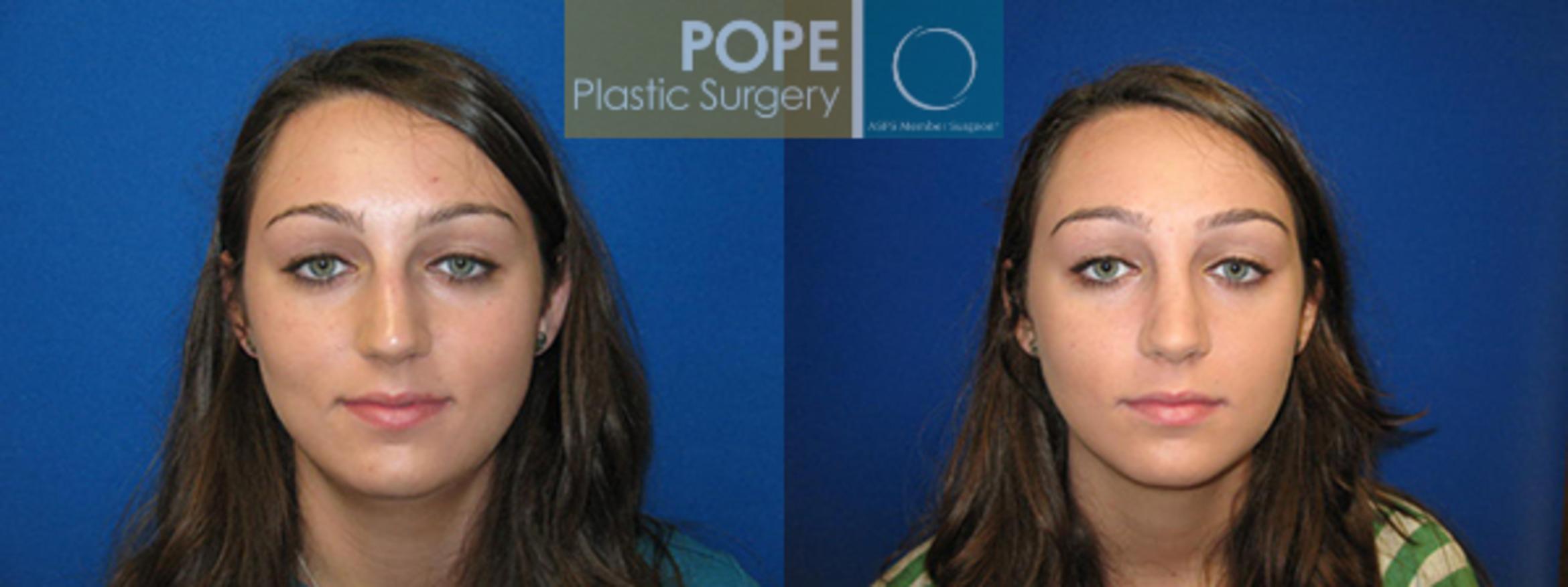 Before & After Rhinoplasty Case 30 View #1 View in Orlando, FL