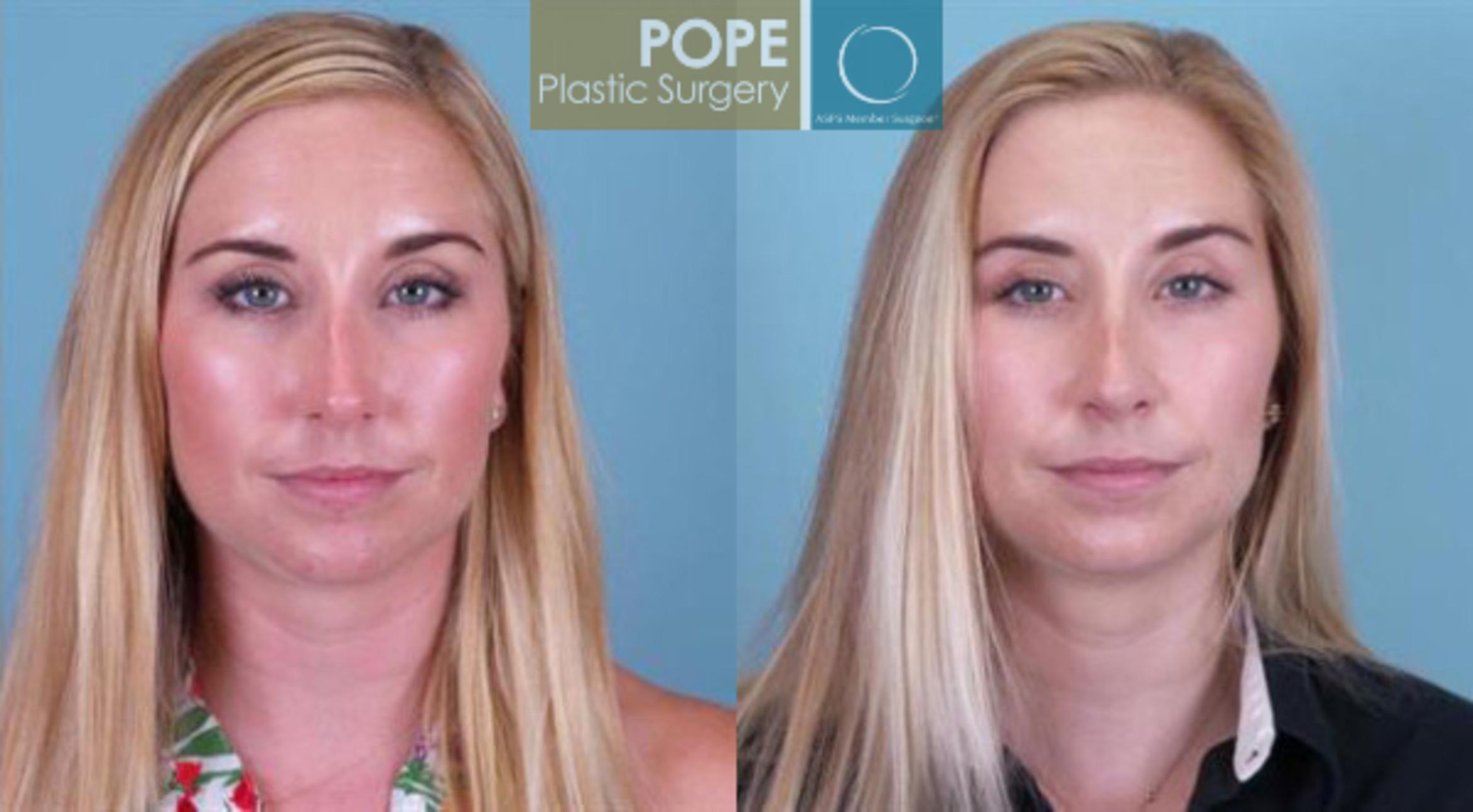 Before & After Rhinoplasty Case 31 View #1 View in Orlando, FL