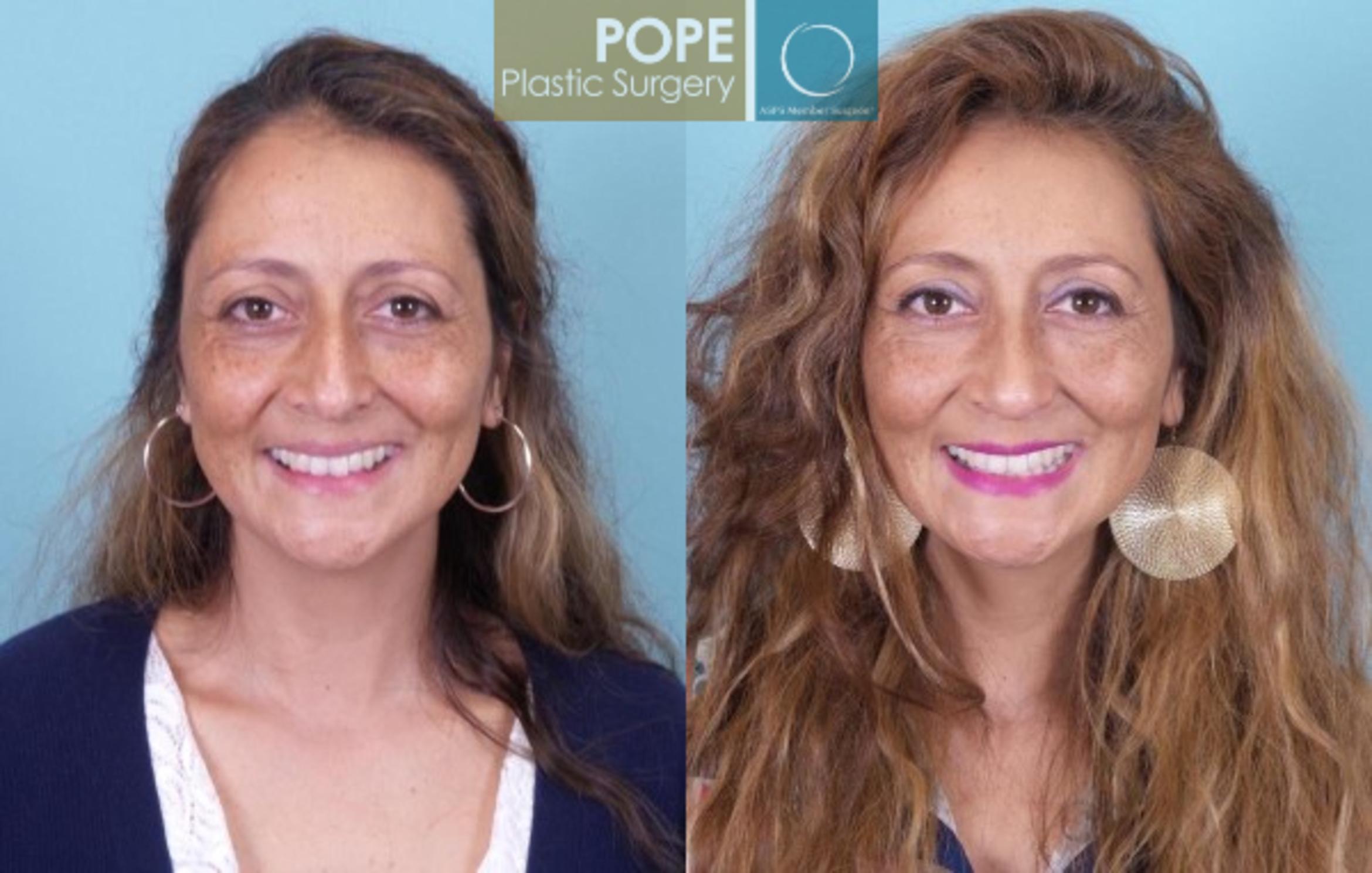 Before & After Rhinoplasty Case 32 View #1 View in Orlando, FL
