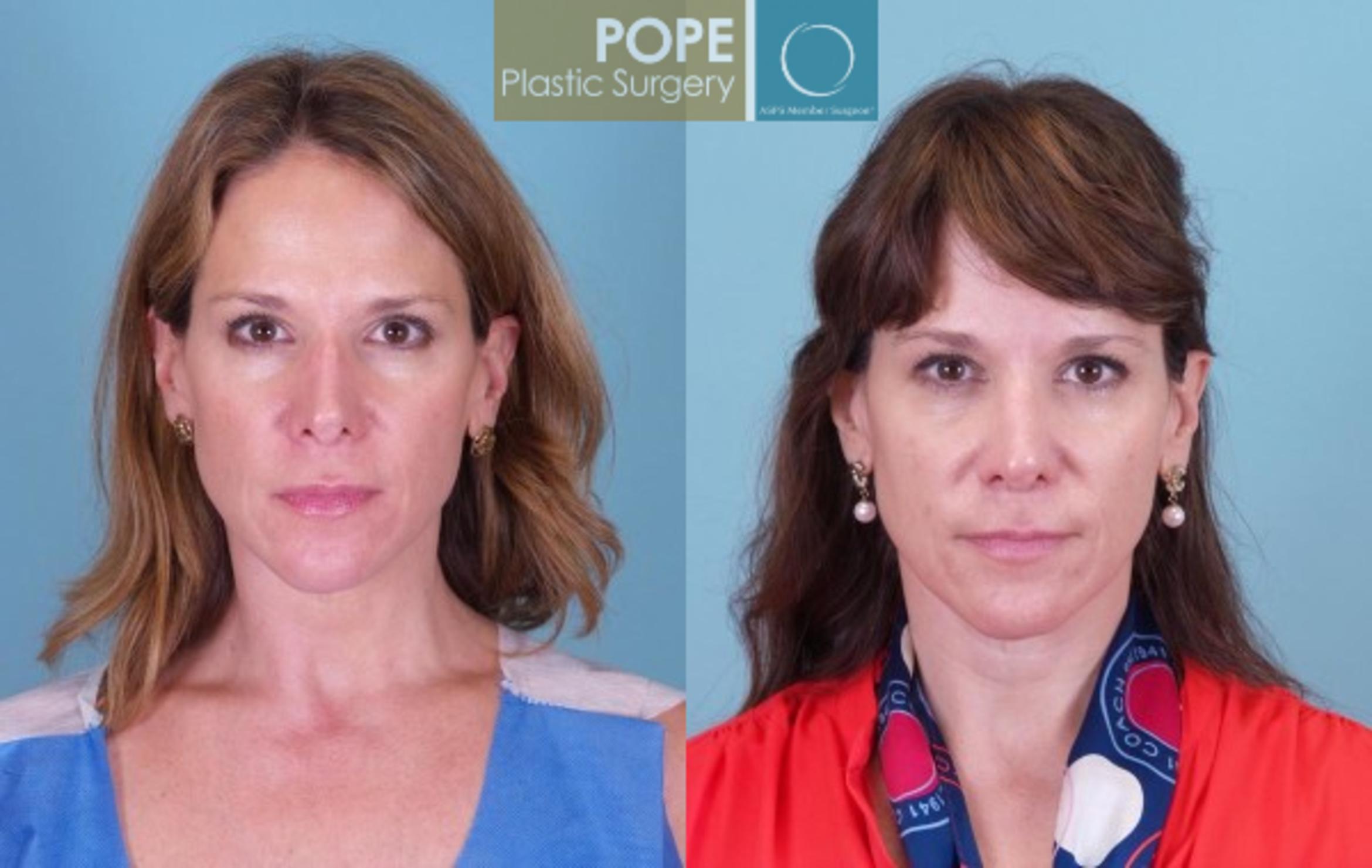 Before & After Rhinoplasty Case 33 View #1 View in Orlando, FL