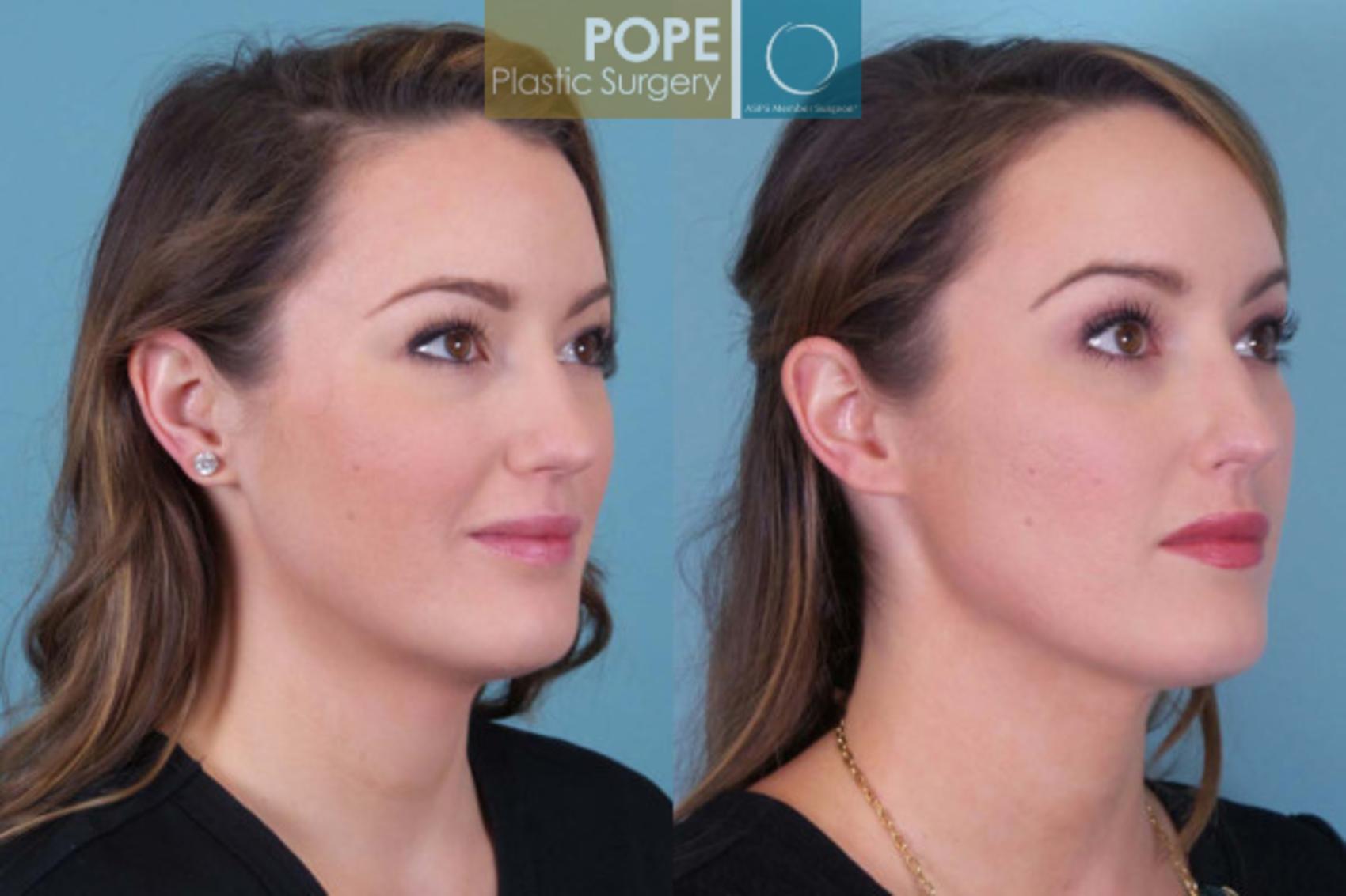 Before & After SCULPTRA® Case 179 View #1 View in Orlando, FL
