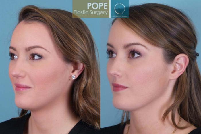 Before & After SCULPTRA® Case 179 View #2 View in Orlando, FL