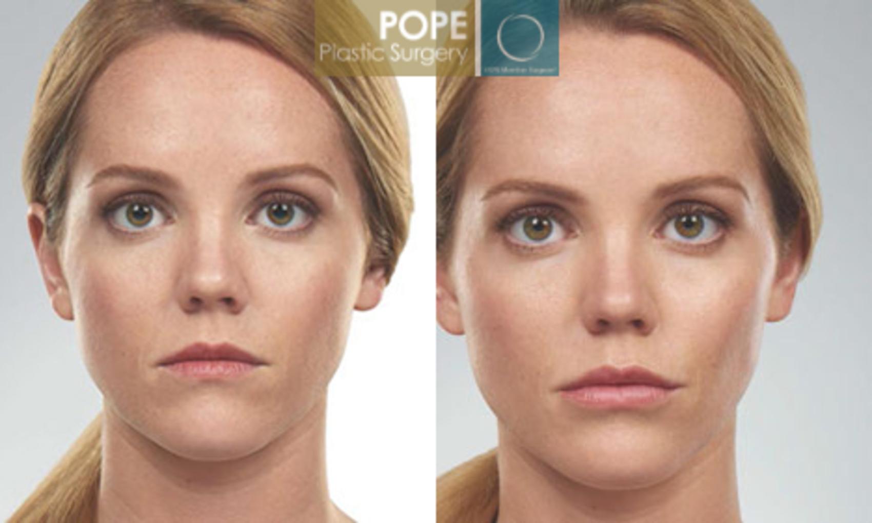 Before & After SCULPTRA® Case 181 View #1 View in Orlando, FL