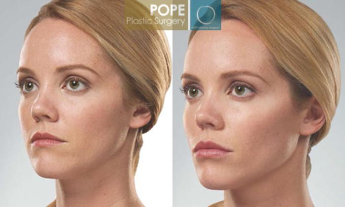 Before & After SCULPTRA® Case 181 View #2 View in Orlando, FL