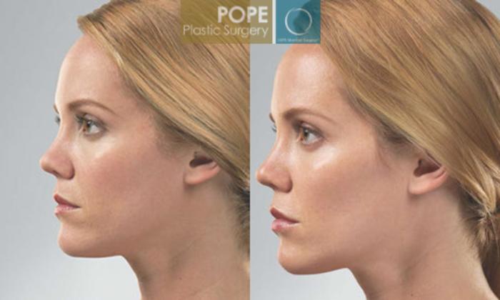 Before & After SCULPTRA® Case 181 View #3 View in Orlando, FL