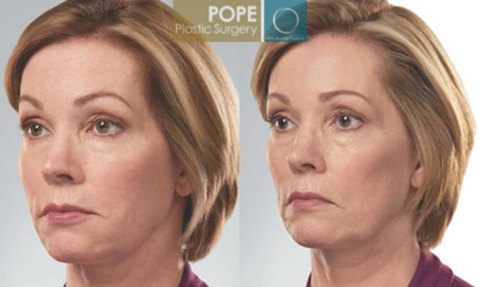 Before & After SCULPTRA® Case 182 View #2 View in Orlando, FL