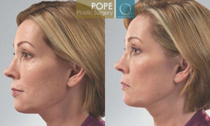 Before & After SCULPTRA® Case 182 View #3 View in Orlando, FL