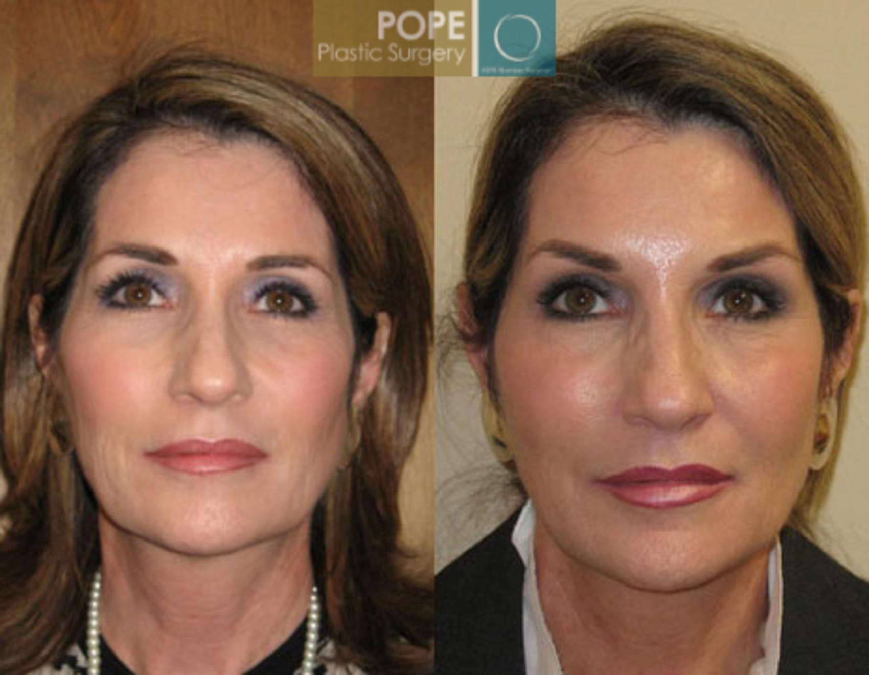 Before & After SCULPTRA® Case 63 View #1 View in Orlando, FL