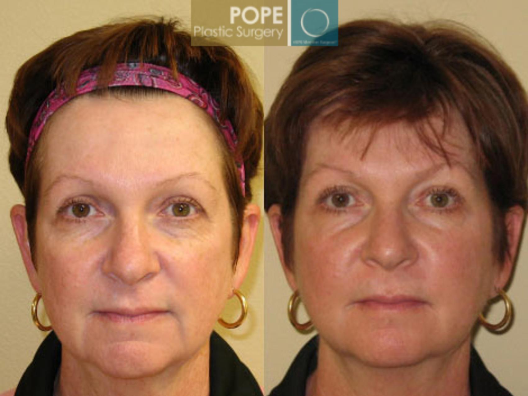 Before & After SCULPTRA® Case 64 View #1 View in Orlando, FL