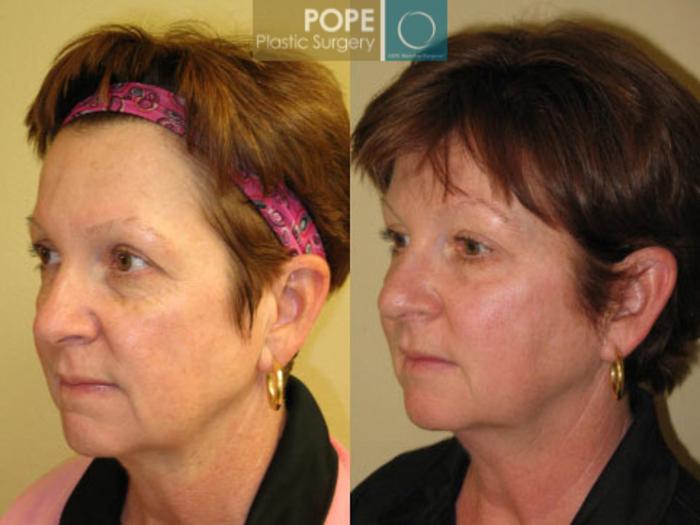 Before & After SCULPTRA® Case 64 View #2 View in Orlando, FL